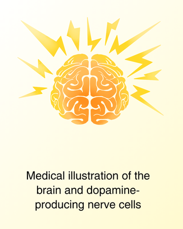 Parkinson’s disease is associated with the loss of dopamine-producing nerve cells involved in controlling movement. Brain illustration showing dopamine changes associated with Parkinson’s disease