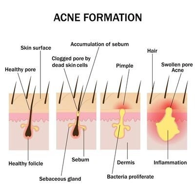 Acne develops when hair follicles become blocked and inflammation occurs. Medical illustration of clogged hair follicle with sebum and inflammation