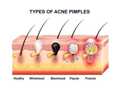 Acne can appear in several forms, from blackheads and whiteheads to inflammatory pimples and deeper lesions. Illustration showing common types of acne