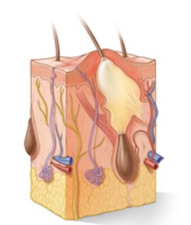 A skin abscess is a localized collection of pus beneath or within the skin, often causing a painful, swollen and tender lump. Skin abscess showing a pocket of pus beneath the skin
